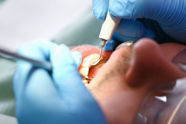Best Emergency Tooth Extraction in Magnolia Springs, AL