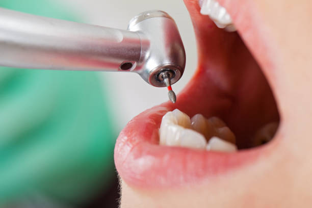 Best Emergency Dental Care for Broken or Chipped Teeth in Magnolia Springs, AL